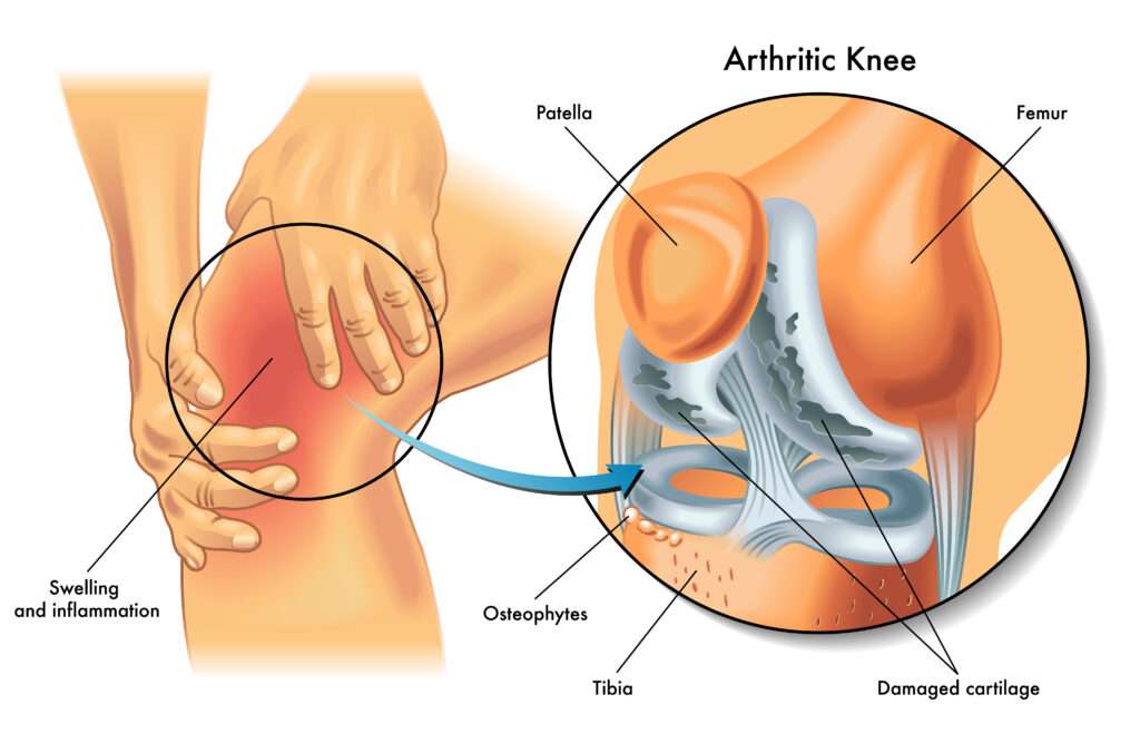 artritis knie