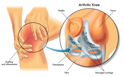 De voedingsgids voor het omgaan met artrose | slimmeweetjes